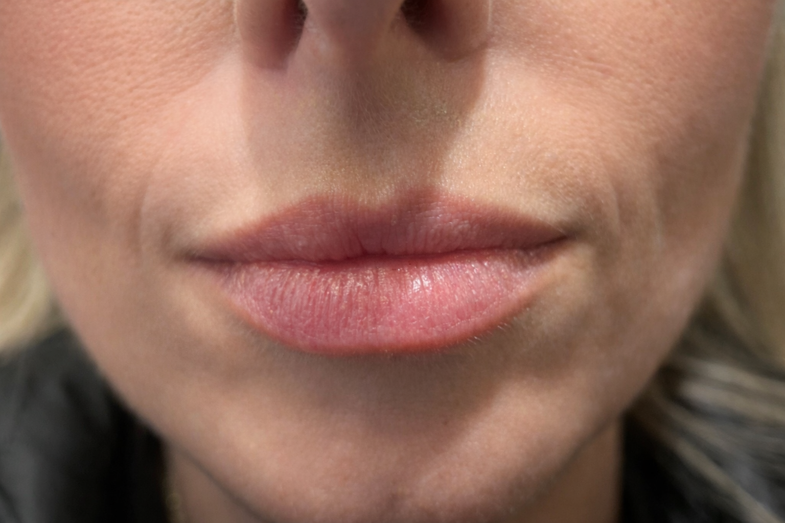 Before Lip Fillers